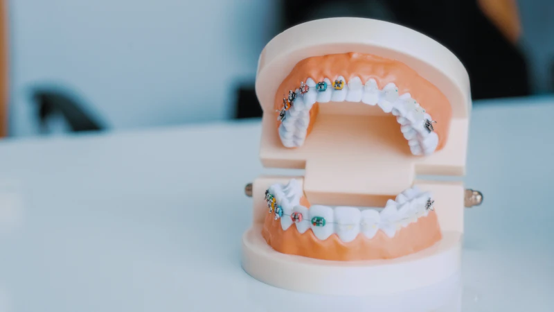 A teeth model wearing metal braces on a table
